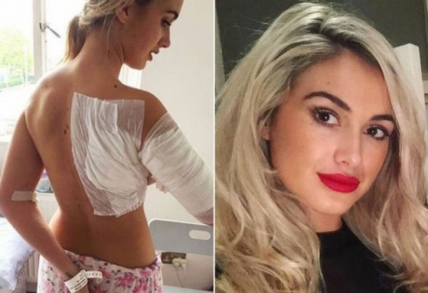 Красиви моделки споделиха ужасяващи снимки след киселинната атака в нощен клуб