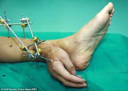 Лекари пришиха отрязана от струг китка за крака на мъж
