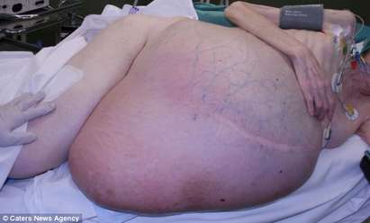 Хирурзи отстраниха 48-килограмов тумор от стомаха на жена
