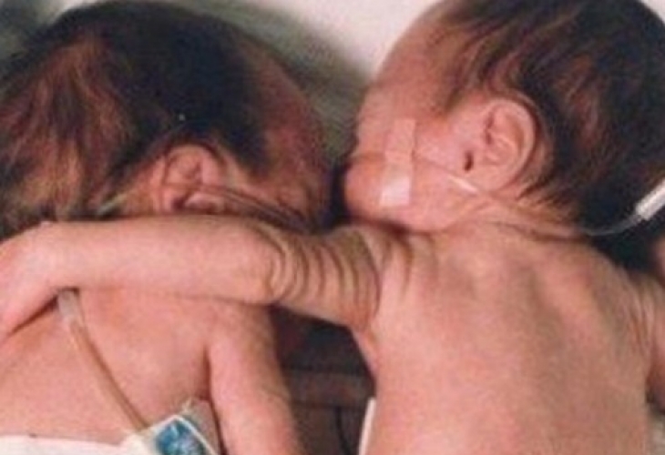 Невероятно чудо преди 18 години! Тази прегръдка завинаги промени медицината! Ето как изглеждат тези близначки днес!